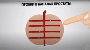 Лечебный массаж простаты как делается